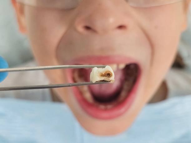 Best Emergency Tooth Extraction in Andale, KS